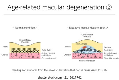 Eye Disease, Exudative Age-Related Macular Degeneration Illustrated