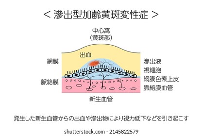 Eye Disease, Exudative Age-Related Macular Degeneration Illustrated - Translation: normal state, exudative age-related macular degeneration; hemorrhages and exudates from the neovascular vessels