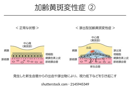 Eye Disease, Exudative Age-Related Macular Degeneration Illustrated - Translation: Normal State, Exudative Age-related Macular Degeneration; Hemorrhages And Exudates From The Neovascular Vessels