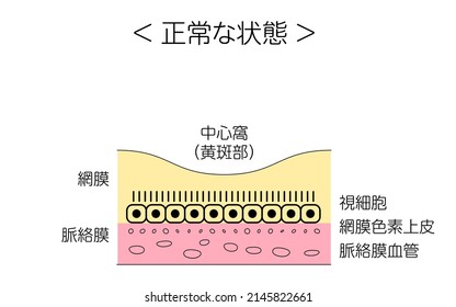 Eye disease, illustration of age-related macular degeneration, normal - Translation: normal conditions, retina, choroid, central fossa (macula), photoreceptor cells, retinal pigment epithelium