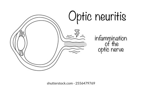 An eye disease manifested by inflammation of the optic nerve with accompanying pain in the eyeballs. Drawn optic neuritis for use in the medical field. Vector illustration.