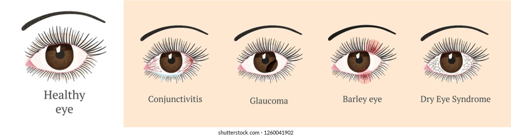 eye-disease-most-common-eye-problemc-stock-vector-royalty-free