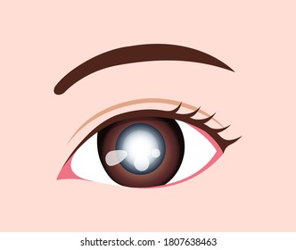 Eye Disease Vector Illustration / Cataract