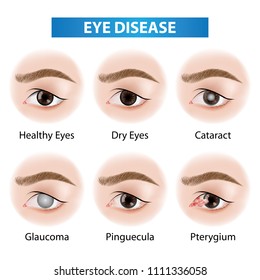 Eye diseases vector illustration