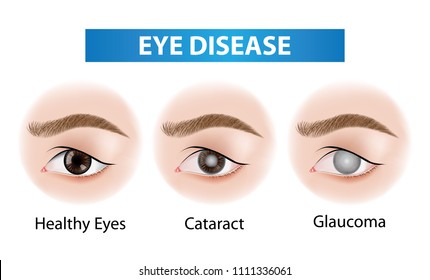 Eye diseases vector illustration