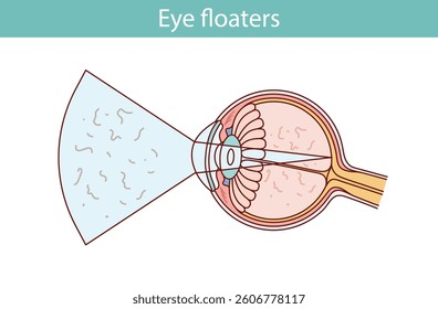 Eye floaters. cartoon style vector illustration
