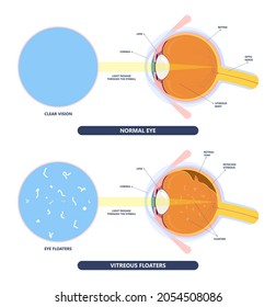 Eye Floaters Fluid Vision Retina Myopia Trauma Surgery Loss Of Light Tear Torn Laser Surgical Repair Older Detached Blurry Shadow Pain Injury Hole Macular Age Treat Blood Dark Lose Wear Pars Plana