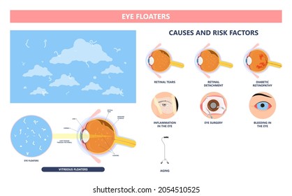 Eye Floaters Fluid Vision Retina Myopia Trauma Surgery Loss Of Light Tear Torn Laser Surgical Repair Older Detached Blurry Shadow Pain Injury Hole Macular Age Treat Blood Dark Lose Wear Pars Plana