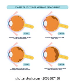 Eye Floaters Fluid Vision Retina Myopia Trauma Surgery Loss Of Light Tear Torn Laser Surgical Repair Older Detached Blurry Shadow Pain Injury Hole Macular Age Treat Blood Dark Lose Wear Pars Plana