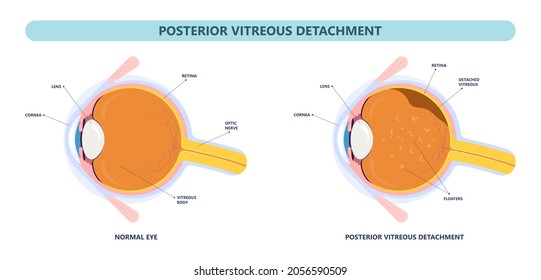 Eye Floaters Fluid Vision Retina Myopia Trauma Surgery Loss Of Light Tear Torn Laser Surgical Repair Older Detached Blurry Shadow Pain Injury Hole Macular Age Treat Blood Dark Lose Wear Pars Plana