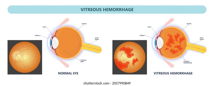 Eye Floaters Fluid Vision Retina Myopia Trauma Surgery Loss Of Light Tear Torn Laser Surgical Repair Older Detached Blurry Shadow Pain Injury Hole Macular Age Treat Blood Dark Lose Wear Pars Plana