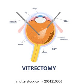 Eye Floaters Fluid Vision Retina Myopia Trauma Surgery Loss Of Light Tear Torn Laser Surgical Repair Older Detached Blurry Shadow Pain Injury Hole Macular Age Treat Blood Dark Lose Wear Pars Plana