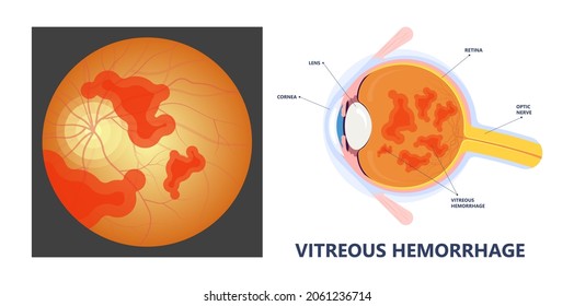 Eye Floaters Fluid Vision Retina Myopia Trauma Surgery Loss Of Light Tear Torn Laser Surgical Repair Older Detached Blurry Shadow Pain Injury Hole Macular Age Treat Blood Dark Lose Wear Pars Plana