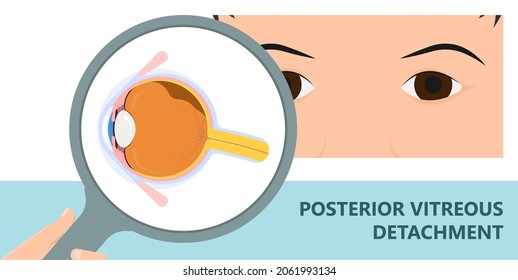 Eye Floaters Fluid Vision Retina Myopia Trauma Surgery Loss Of Light Tear Torn Laser Surgical Repair Older Detached Blurry Shadow Pain Injury Hole Macular Age Treat Blood Dark Lose Wear Pars Plana