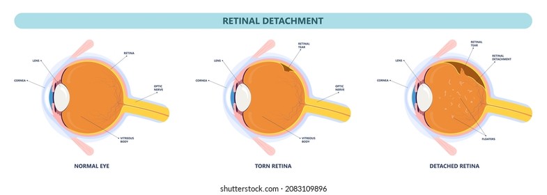 Eye Floaters Fluid Vision Retina Myopia Trauma Surgery Loss Of Light Tear Torn Laser Surgical Repair Older Detached Blurry Shadow Pain Injury Hole Macular Age Treat Blood Dark Lose Wear Pars Plana