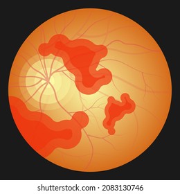 Eye Floaters Fluid Vision Retina Myopia Trauma Surgery Loss Of Light Tear Torn Laser Surgical Repair Older Detached Blurry Shadow Pain Injury Hole Macular Age Treat Blood Dark Lose Wear Pars Plana