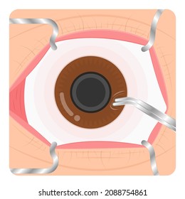 Eye Floaters Fluid Vision Retina Myopia Trauma Surgery Loss Of Light Tear Torn Laser Surgical Repair Older Detached Blurry Shadow Pain Injury Hole Macular Age Treat Blood Dark Lose Wear Pars Plana