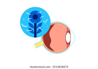 Eye Floater oder Muscae volitantes Poster. Myodesopsie-Konzept, Augenuntersuchung. Glasartiger Humor, Gel im Augapfel. Kollagenfasern im Auge. Pupille, Retina-Makula, Vektorgrafik