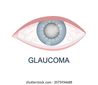 Eye with glaucoma closeup view. Hazy, redness, watery eyeball. Anatomically accurate human organ of vision. Aging visual problems. Vector illustration.