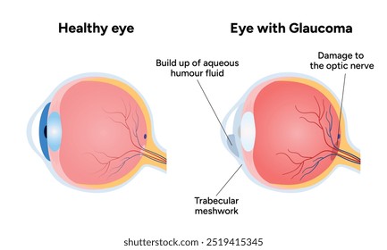 Olho com doença de glaucoma e infográfico médico do olho saudável com anatomia do olho óptico humano