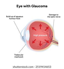 Ojo con enfermedad de glaucoma, infografía médica con anatomía óptica del ojo humano