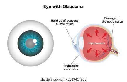 Ojo con enfermedad de glaucoma, infografía médica con anatomía óptica del ojo humano