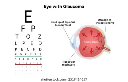 Ojo con enfermedad de glaucoma, infografía médica con anatomía óptica del ojo humano