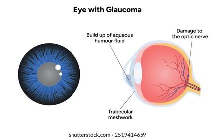 Ojo con enfermedad de glaucoma, infografía médica con anatomía óptica del ojo humano