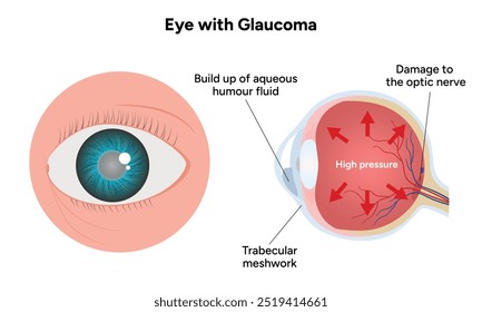 Ojo con enfermedad de glaucoma, infografía médica con anatomía óptica del ojo humano