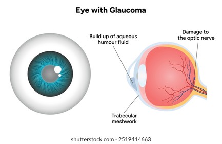 Olho com doença de glaucoma, infográfico médico com anatomia ótica ocular humana