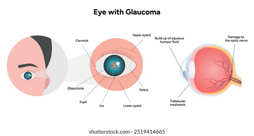 Ojo con enfermedad de glaucoma, infografía médica con anatomía óptica del ojo humano