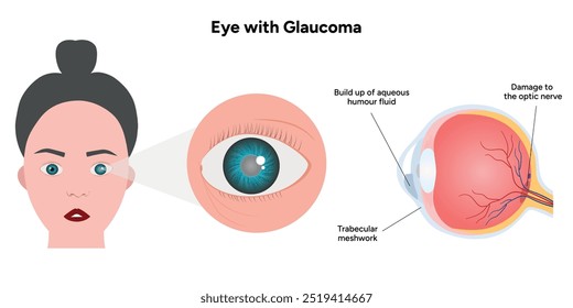 Ojo con enfermedad de glaucoma, infografía médica con anatomía óptica del ojo humano