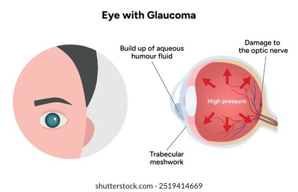 Ojo con enfermedad de glaucoma, infografía médica con anatomía óptica del ojo humano