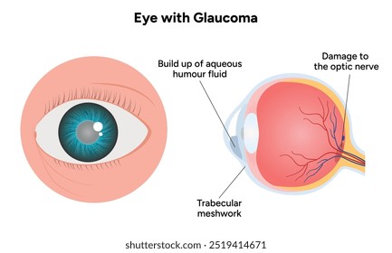 Olho com doença de glaucoma, infográfico médico com anatomia ótica ocular humana