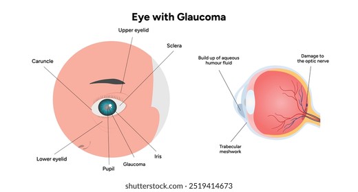 Ojo con enfermedad de glaucoma, infografía médica con anatomía óptica del ojo humano