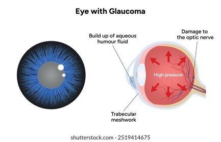 Ojo con enfermedad de glaucoma, infografía médica con anatomía óptica del ojo humano