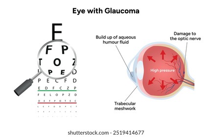 Ojo con enfermedad de glaucoma, infografía médica con anatomía óptica del ojo humano