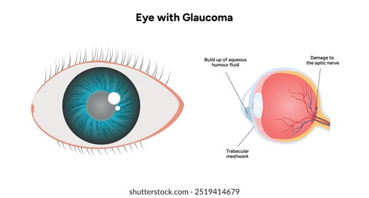 Ojo con enfermedad de glaucoma, infografía médica con anatomía óptica del ojo humano