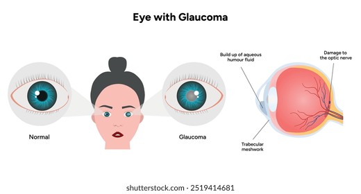 Ojo con enfermedad de glaucoma, infografía médica con anatomía óptica del ojo humano