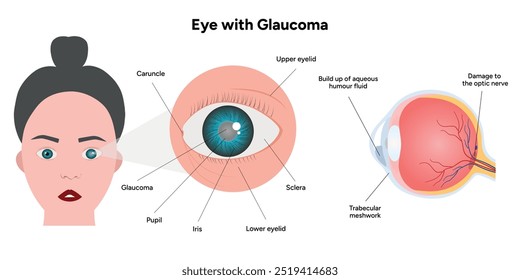 Ojo con enfermedad de glaucoma, infografía médica con anatomía óptica del ojo humano