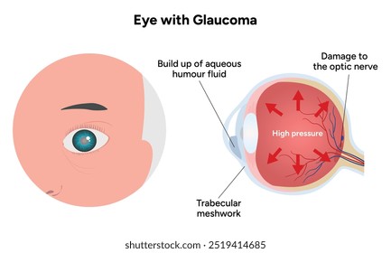 Ojo con enfermedad de glaucoma, infografía médica con anatomía óptica del ojo humano