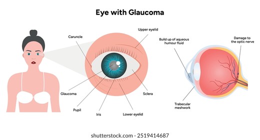 Ojo con enfermedad de glaucoma, infografía médica con anatomía óptica del ojo humano