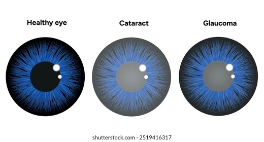 Ojo con enfermedad de glaucoma, infografía médica con anatomía óptica del ojo humano