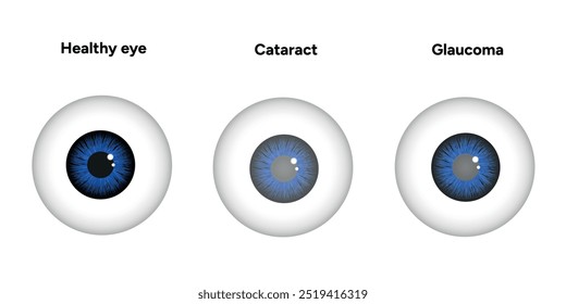 Ojo con enfermedad de glaucoma, infografía médica con anatomía óptica del ojo humano