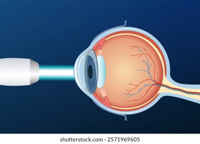 Eye with glaucoma, medical infographics with the anatomy of the human eye optics. Laser eye surgery LASIK