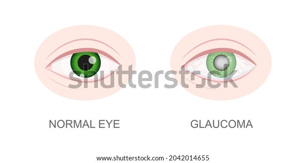 Eye healthy
and with glaucoma closeup view. Normal and hazy, redness, watery
eyeball. Anatomically accurate human organ of vision. Aging visual
problems. Vector cartoon
illustration.