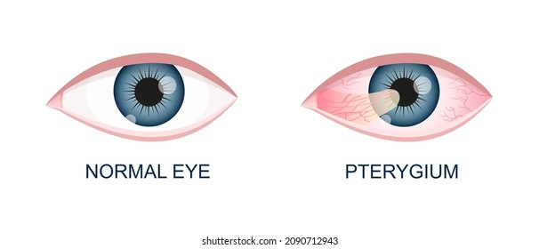 Eye healthy and with pterygium. Conjunctival degeneration before and after surgery. Eye disease. Human organ of vision with pathology. Vector realistic illustration.