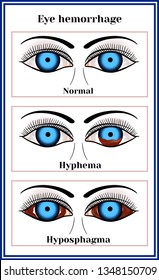 Miosis Is Of The Pupil