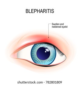 Eye of human. Blepharitis is a inflammation, and reddening of the eyelid. Human anatomy. Vector diagram for educational, and medical use. 