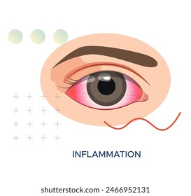 Eye Inflammation due to Infection - Pink Eye - Stock Illustration as EPS 10 File